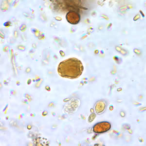 Bhominis_cyst_wtmt_io.jpg Figure A