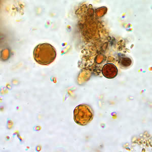 Bhominis_cyst_wtmt_io2.jpg Figure B