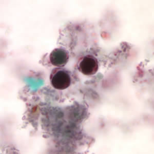 Bhominis_cyst_tric.jpg Figure A