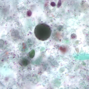 Bhominis_cyst_tric3.jpg Figure C