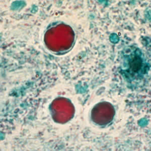 Bhominis_cyst_tric5.jpg Figure E