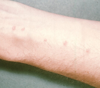 Cercarial_dermatitis.jpg Figure A