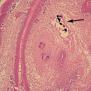 Diphyllobothrium_tissue_WA_100x1.jpg Figure A