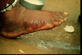 Dracunculiasis2_DPDx.jpg