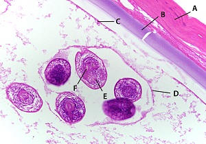 Eg_cyst Figure A