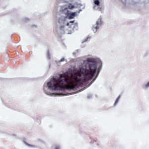 E_vermicularis_eggs_tissue1.jpg