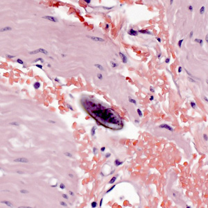 E_vermicularis_eggs_tissue2.jpg