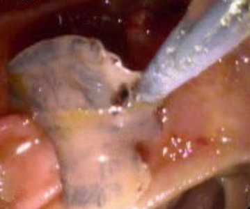 Fasciola_ERCP_India_A.jpg