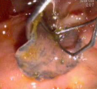 Fasciola_ERCP_India_B.jpg