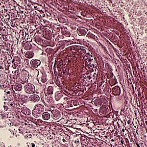 Balamuthia_cyst_HE_Vish1.jpg
