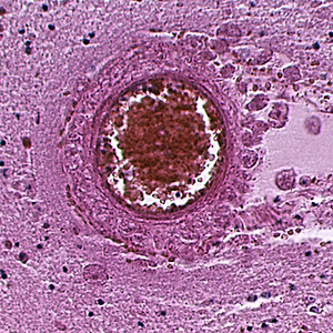 Balamuthia_cyst_HE_Vish2.jpg