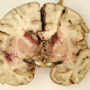 Brain_pathology_Cook2.jpg