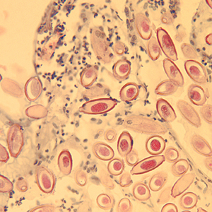 Figure D: Eggs of C. hepatica in liver stained with H&E.