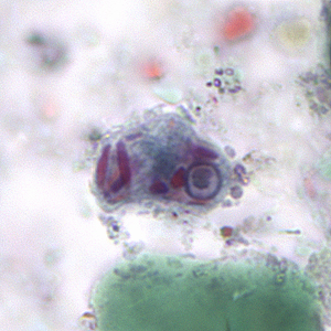 Epolecki_cyst_tric.jpg Figure A