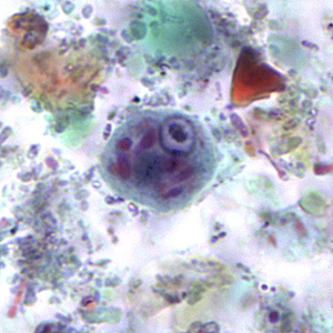 Epolecki_cyst_tric2.jpg Figure B