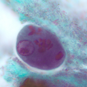 Epolecki_cyst_tric3.jpg Figure C