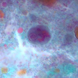 Epolecki_cyst_tric4.jpg Figure D