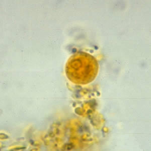 Ehartmanni_cyst_wtmt.jpg Figure A