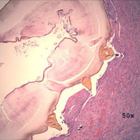Myiasis_tissue_NYC3.jpg Figure C