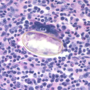 Paragonimus_egg_lung_biopsy2.jpg