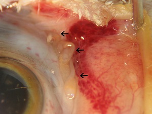 Adult_E Philophthalmiasis image