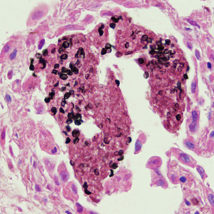 Pneumocystis_HB1.jpg