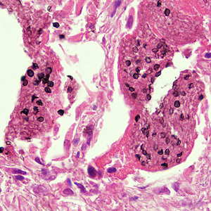 Pneumocystis_HB2.jpg