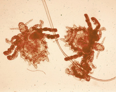Phthirus_pubis_three.jpg