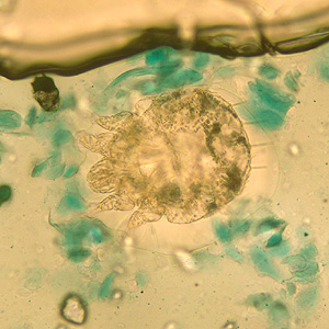 Sarcoptes_scabiei_BAM1.jpg