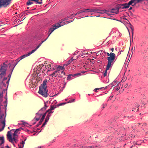 scabies_tissue_BAM1.jpg