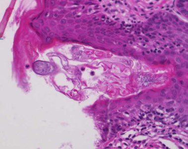 Demodex_tissue_Westchester.jpg