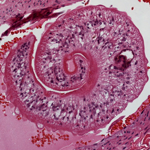 Schistosoma_lung_Harvard1.jpg