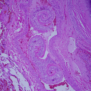Schistosoma_lung_Harvard2.jpg