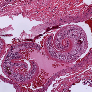 Schistosoma_lung_Harvard3.jpg