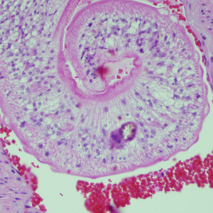 Schistosoma_lung_Harvard4.jpg