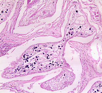 Sparganosis_groin_Paraguay_BAM3.jpg