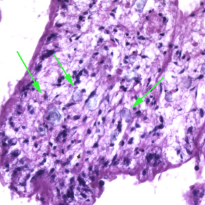 Sparganosis_lung_Taiwan_BAM2.jpg