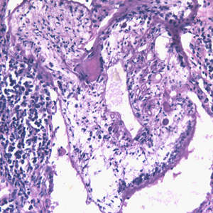 Sparganosis_lung_Taiwan_BAM3.jpg