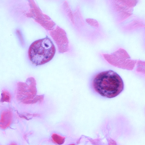 S_stercoralis_intbiopsy_1000x_BAM1.jpg Figure E