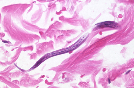 S_stercoralis_intbiopsy_400x_BAM1.jpg