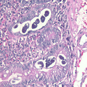 Strongyloides_duodenal_biopsy_HE200x.jpg