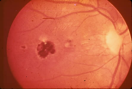 Congen_Toxo_ocular.jpg