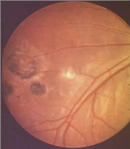 Congen_Toxo_ocular2.jpg