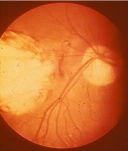 Toxo_ocular.jpg