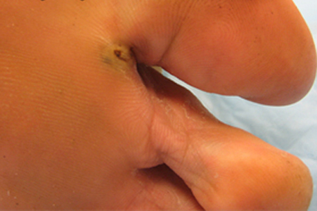 Tunga_lesion_A_PHSID.jpg