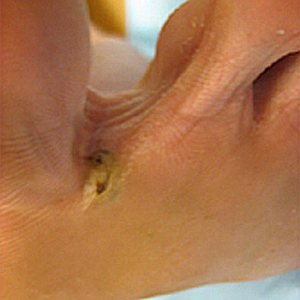 Tunga_lesion_B_PHSID.jpg