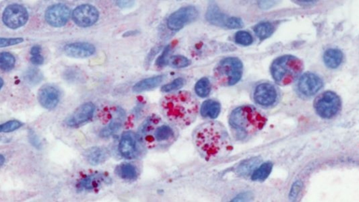 Immunohistochemical stain demonstrating E. chaffeensis morulae within monocytes in the kidney of a patient with ehrlichiosis.