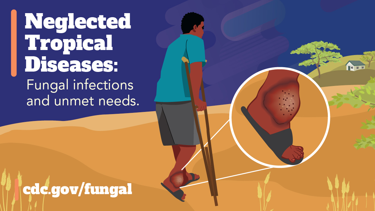 Neglected Tropical Diseases (Facebook) A person using crutches and wearing open toed shoes walking through a rural, arid area. The person’s lower extremity is visibly affected by a fungal infection and is magnified showing skin lesions on their ankle. Text reads. “Neglected tropical diseases: fungal infections and unmet needs.”