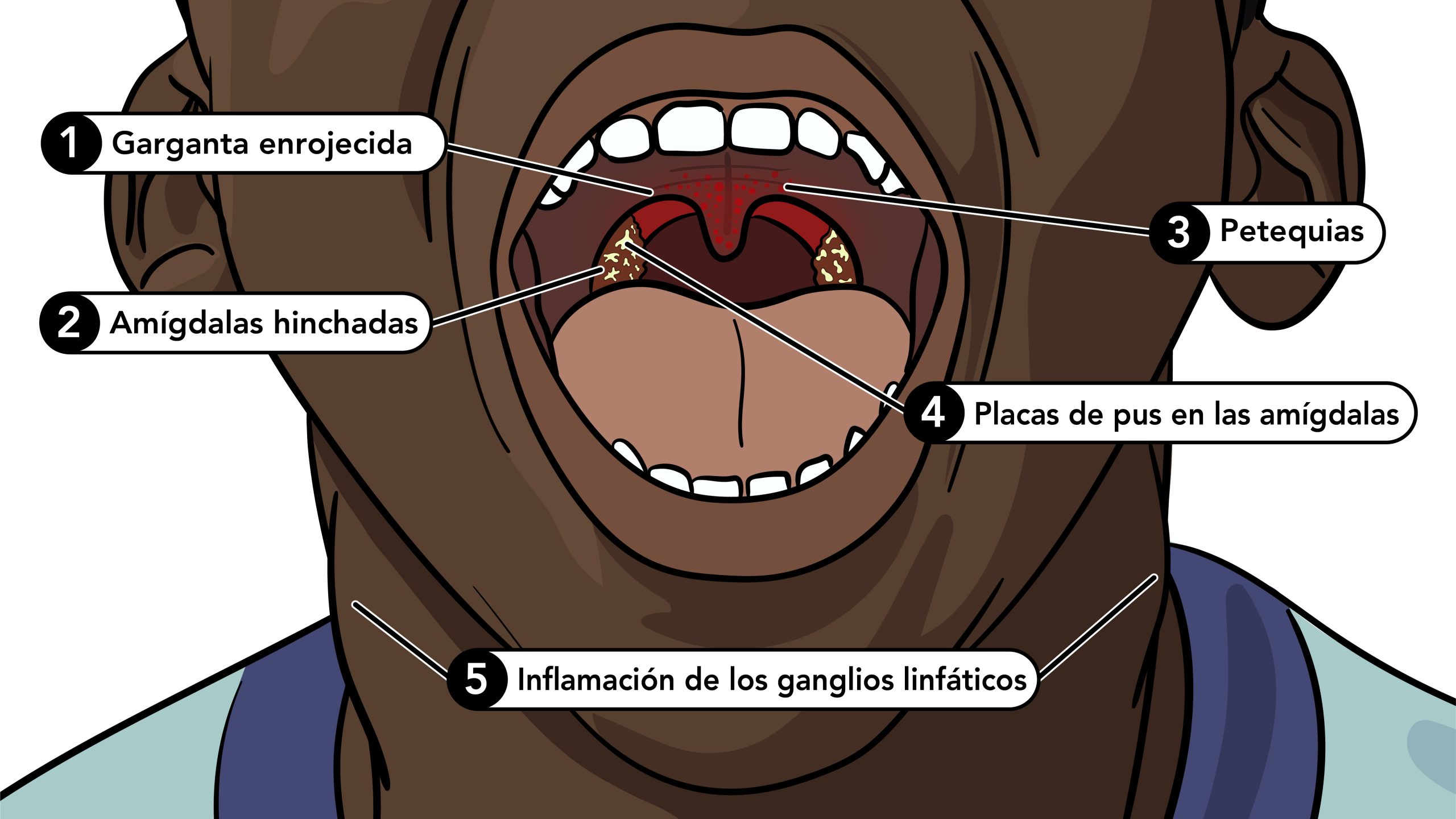 Ilustración con etiquetas del interior de la boca de una persona con infección de garganta por estreptococos.
