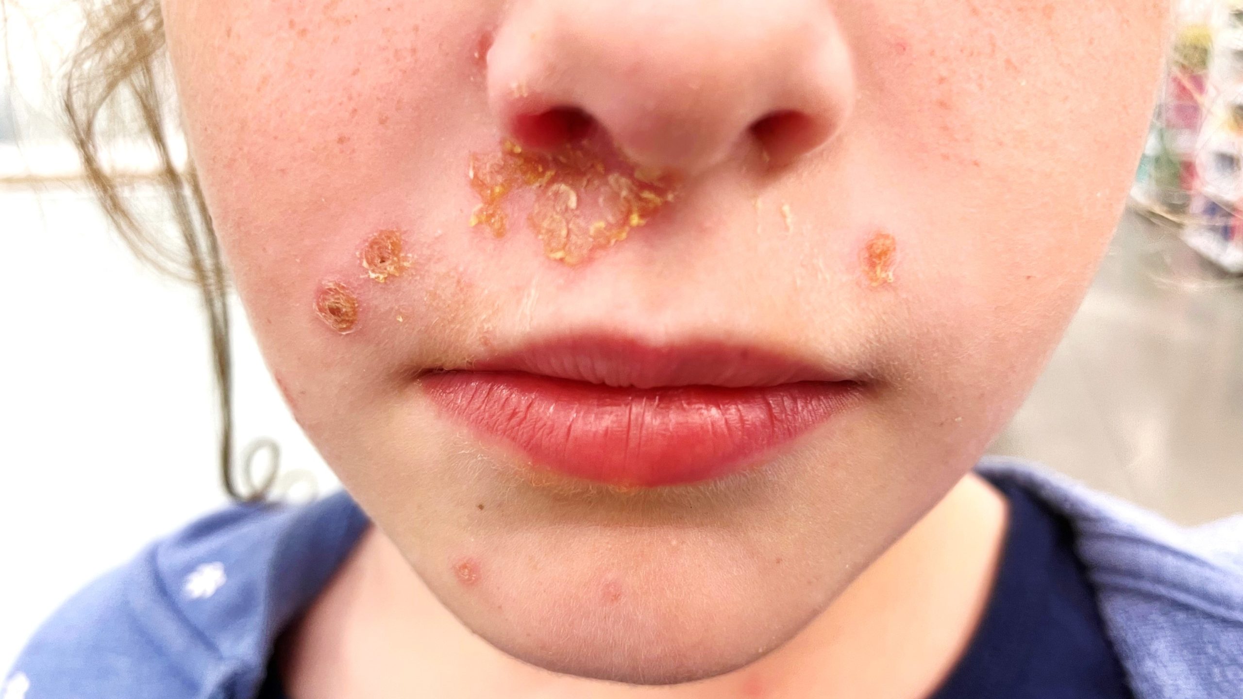 Impetigo-face "Honey-colored' scabs on the face of a school-age child.